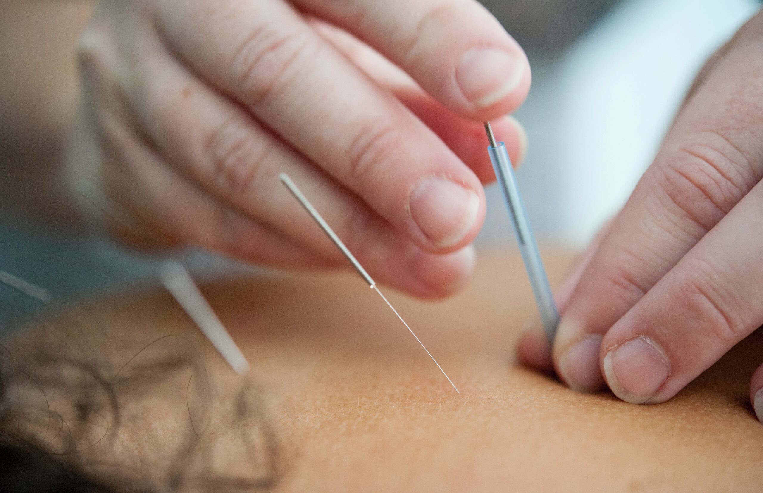 Acupuncture services